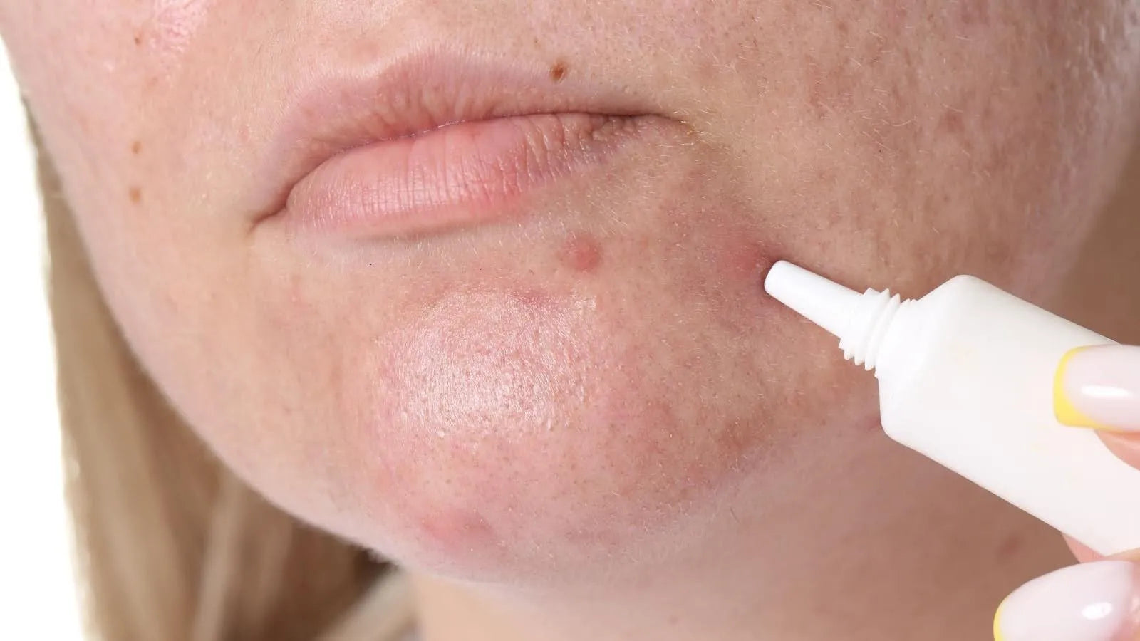 Acne Care for Sensitive Skin