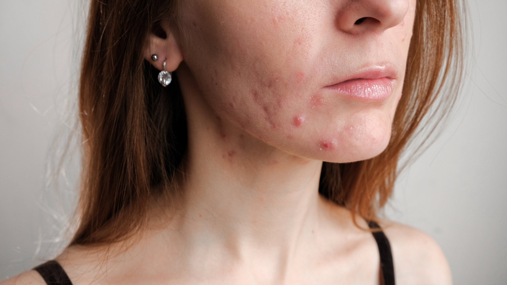Acne Myths You Should Know Of