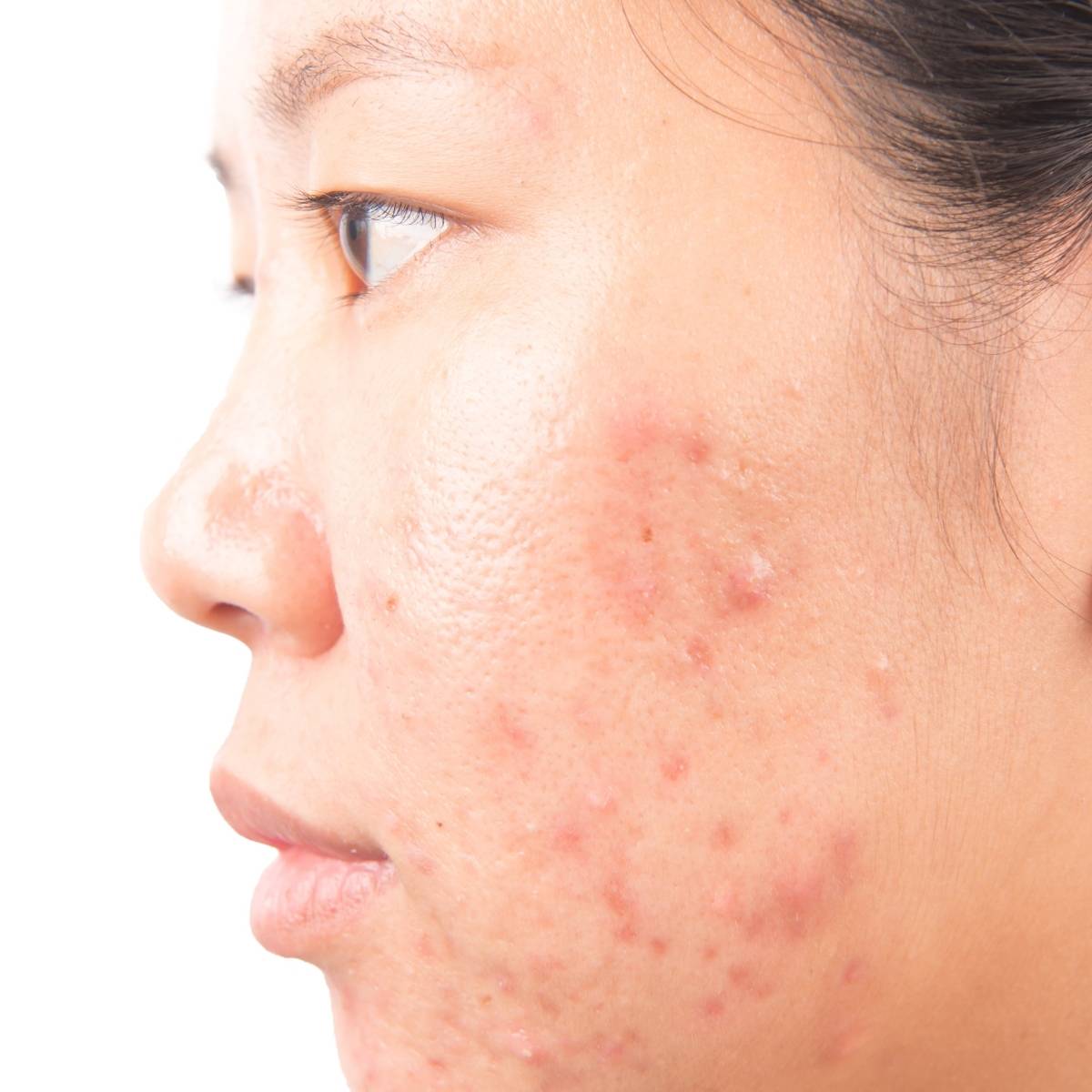 An image of a persons face with hormonal acne