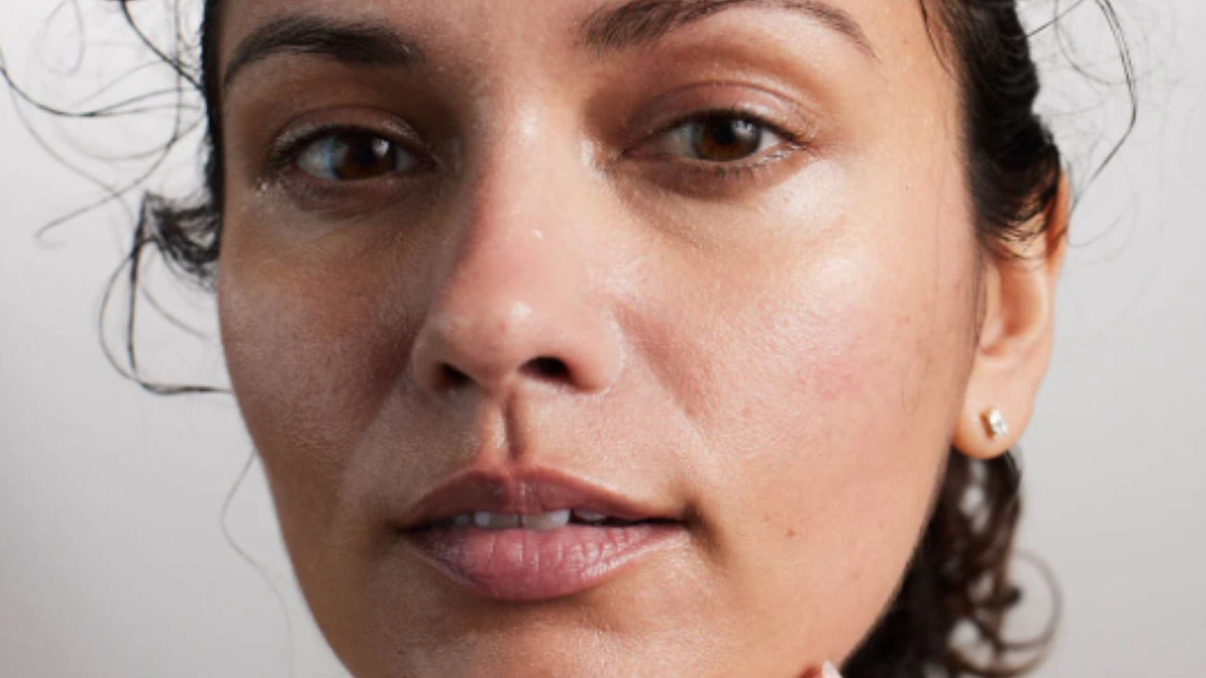 How Long Do Broken Capillaries Take to Heal