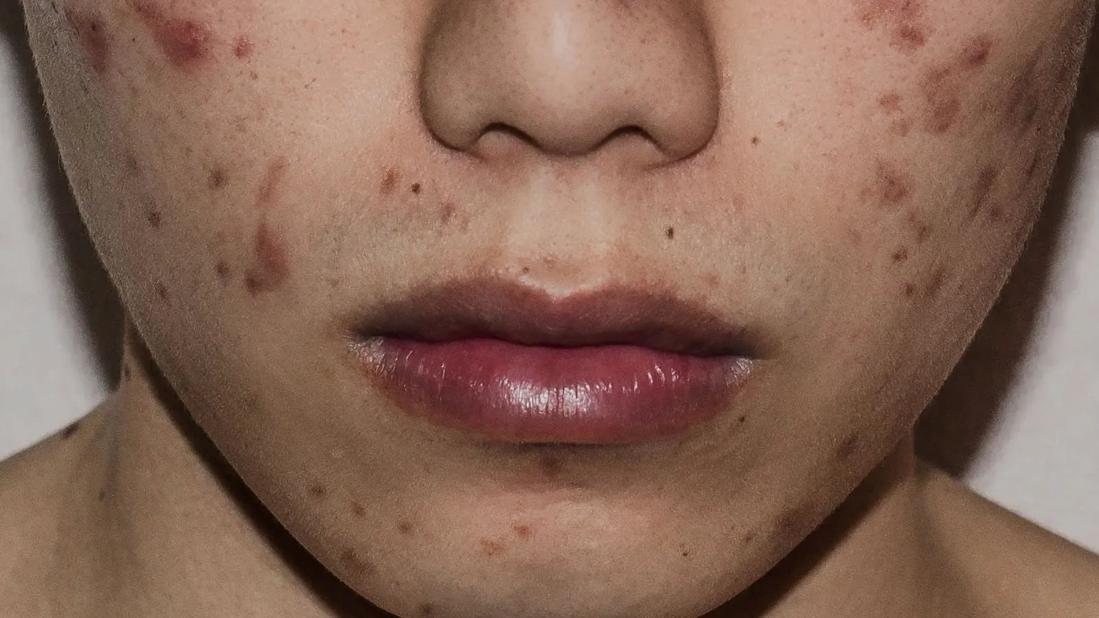 How to Prevent Acne Scars