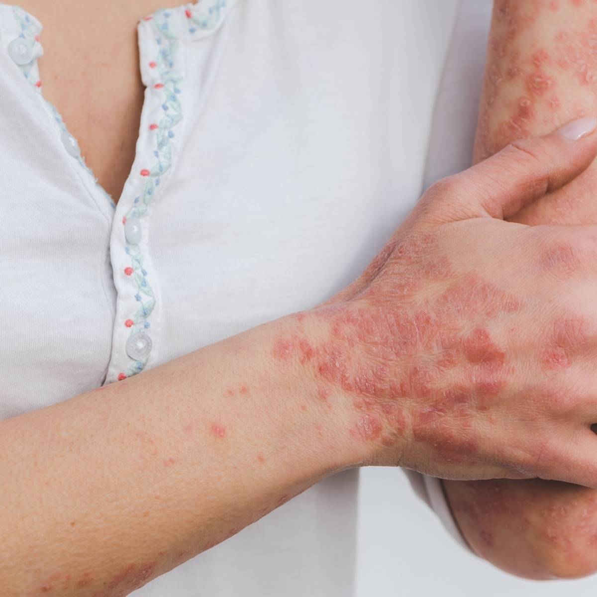 An image of someones hand with Psoriasis