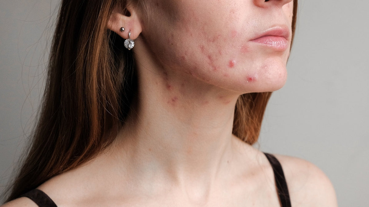 Skin Barrier Repair: How to Rebuild a Damaged Skin Barrier