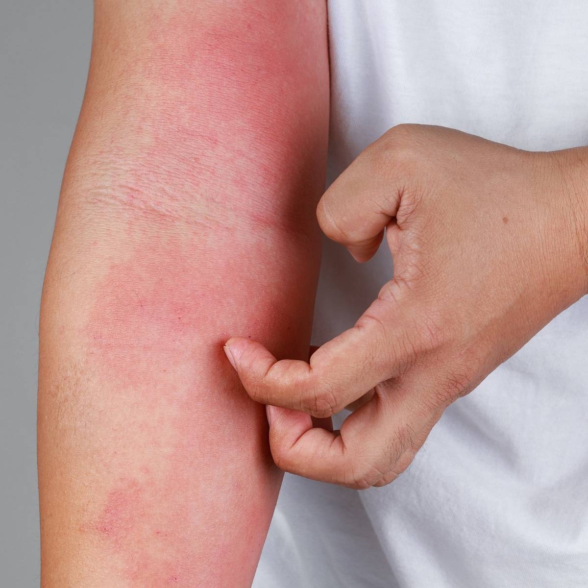 An image of a man scratching his arm eczema