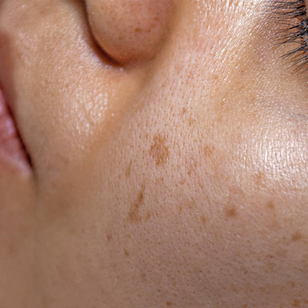 An image of hyperpigmentation on someones face