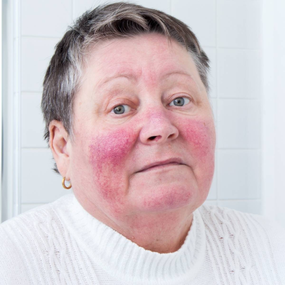 red light therapy for rosacea