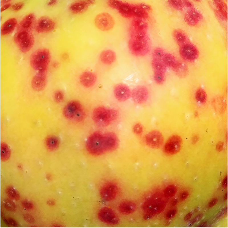 An image of acne on skin