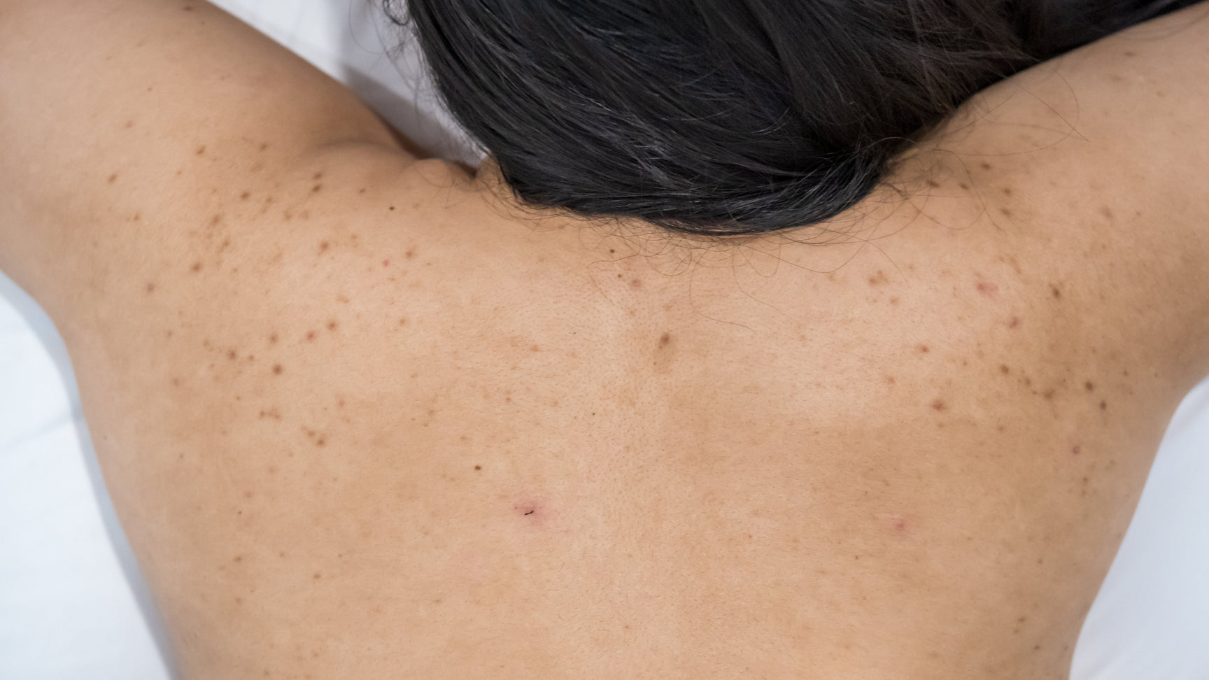  Bacne: What are they, Types, Causes, Prevention