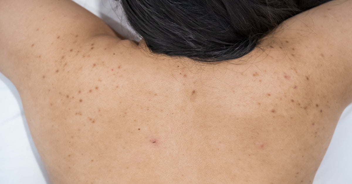 Bacne Types, Causes and Prevention Guide - Solawave