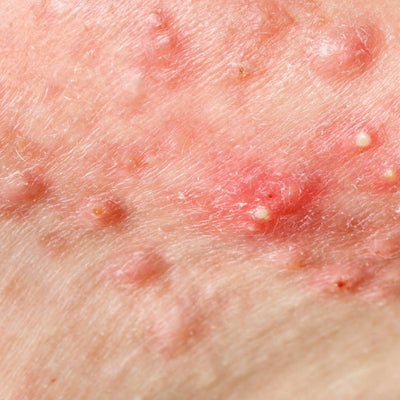 Cystic Acne, Explained