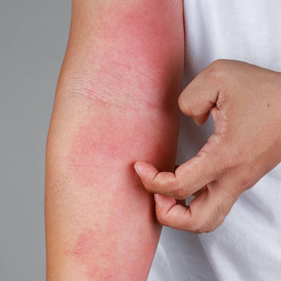 5 Things to Know About Eczema