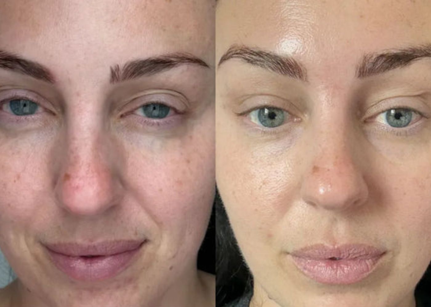 LED Face Masks vs Chemical Peels