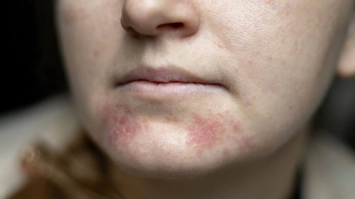 Perioral Dermatitis Management: Natural Treatment