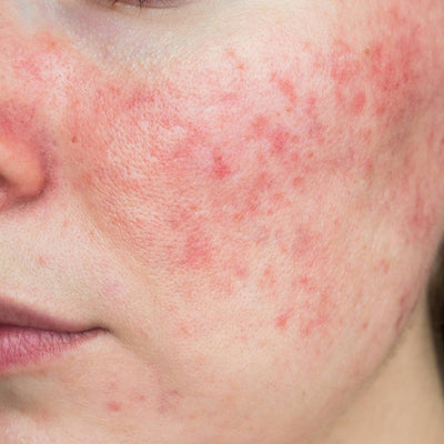5 Things to Know About Rosacea