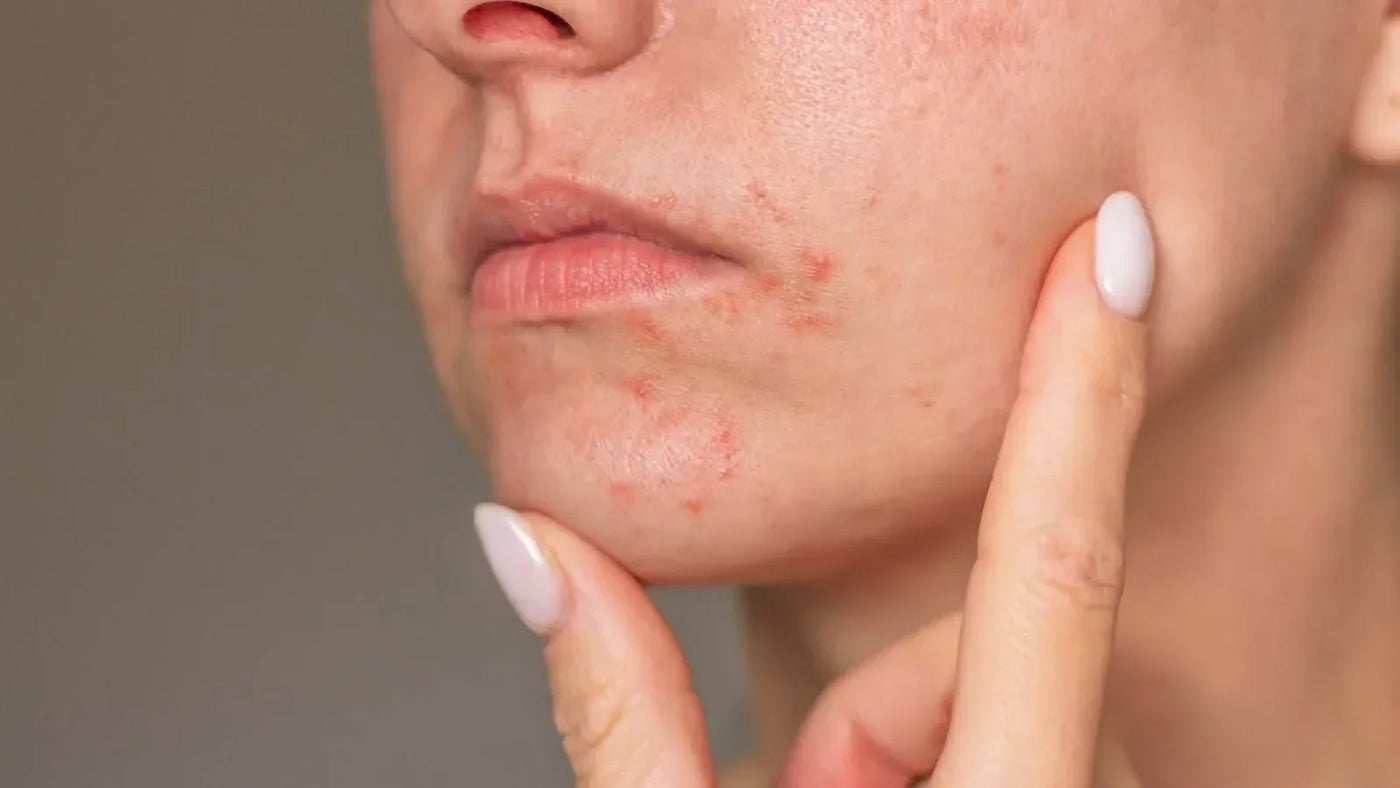 What is Perioral Dermatitis