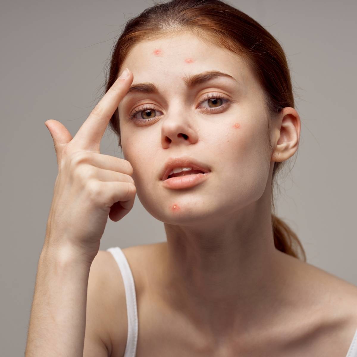 red light therapy acne