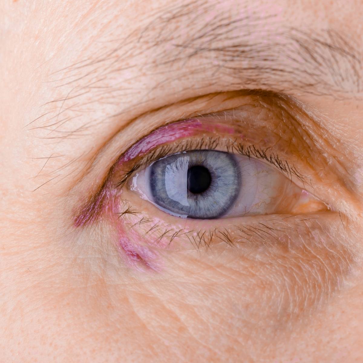 An image of broken capillaries around an eye
