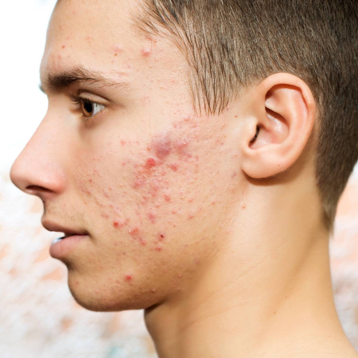 blue light for acne