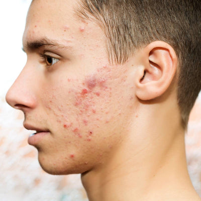 Fungal Acne, Explained
