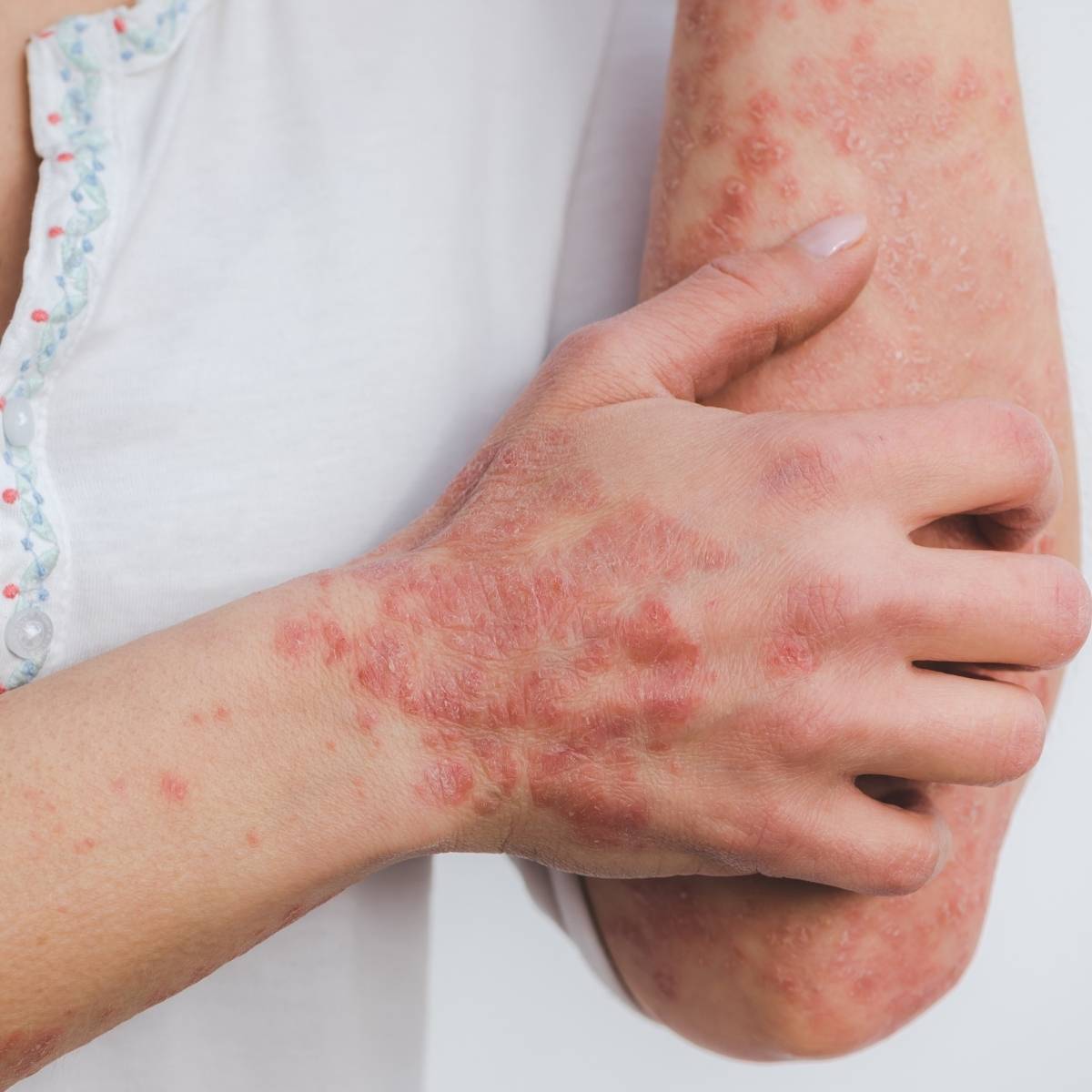 An image of someones hand with psoriasis on it