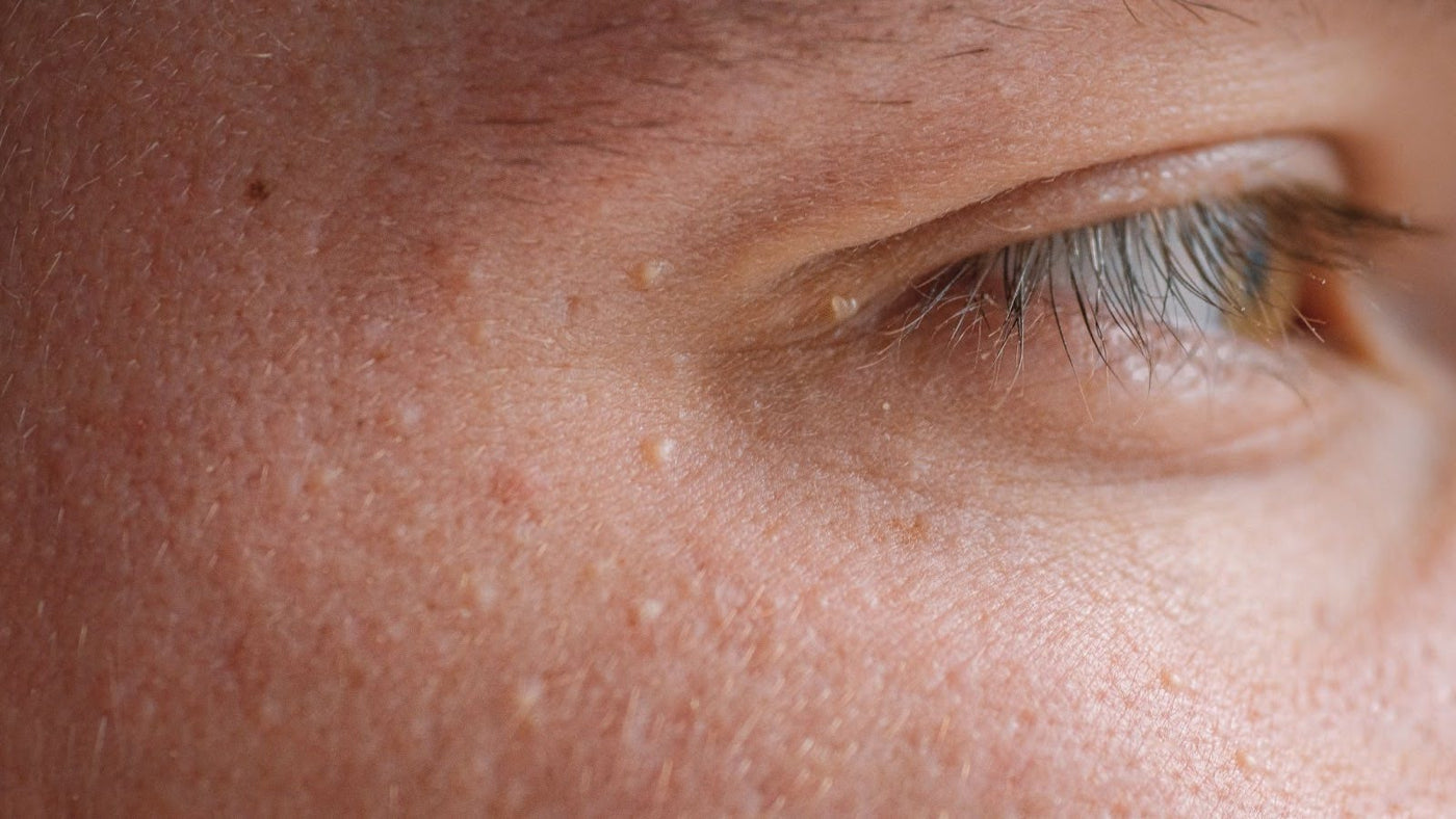  What is Milia and Why Do These Tiny Bumps Happen