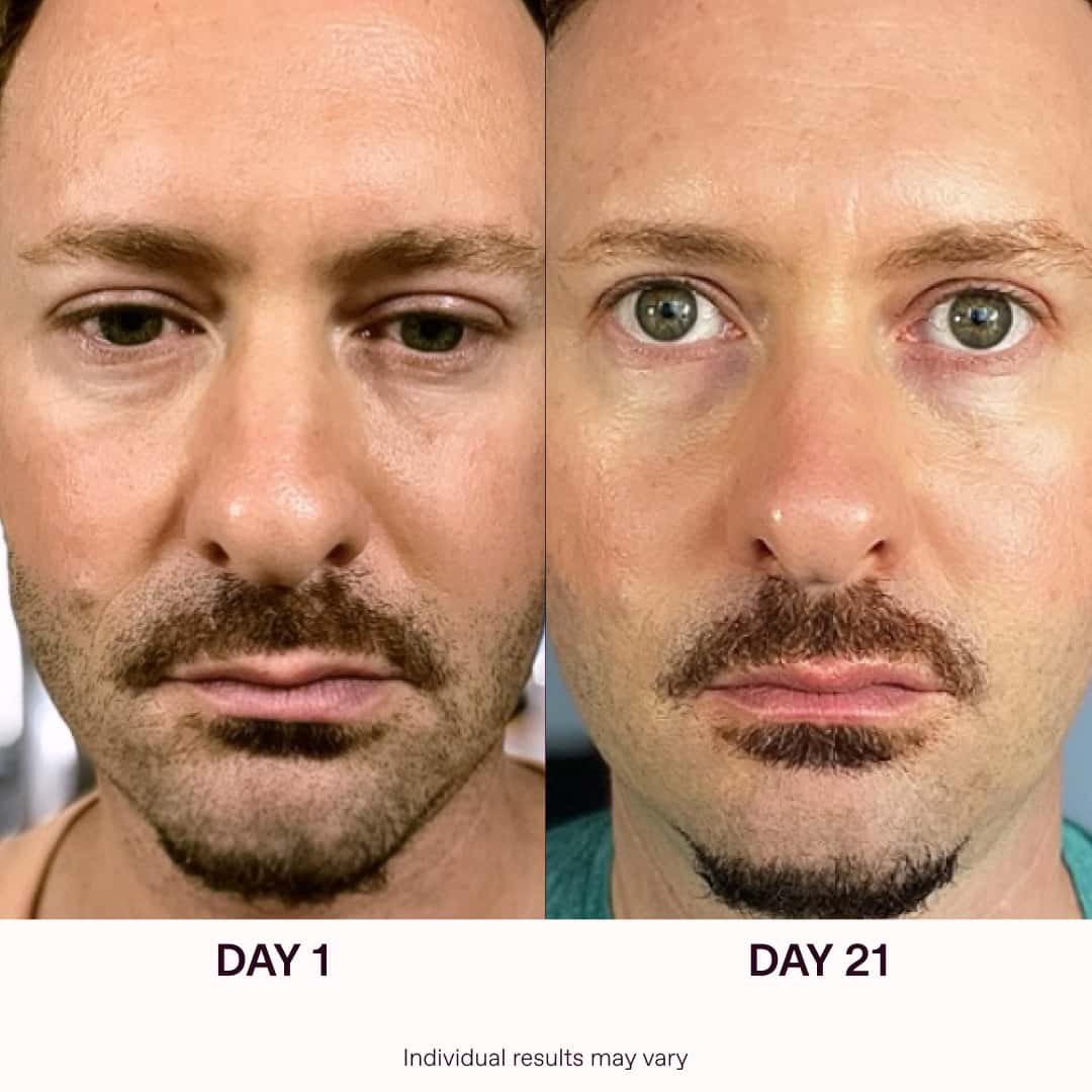 Red Light Therapy Before And After Results | Solawave