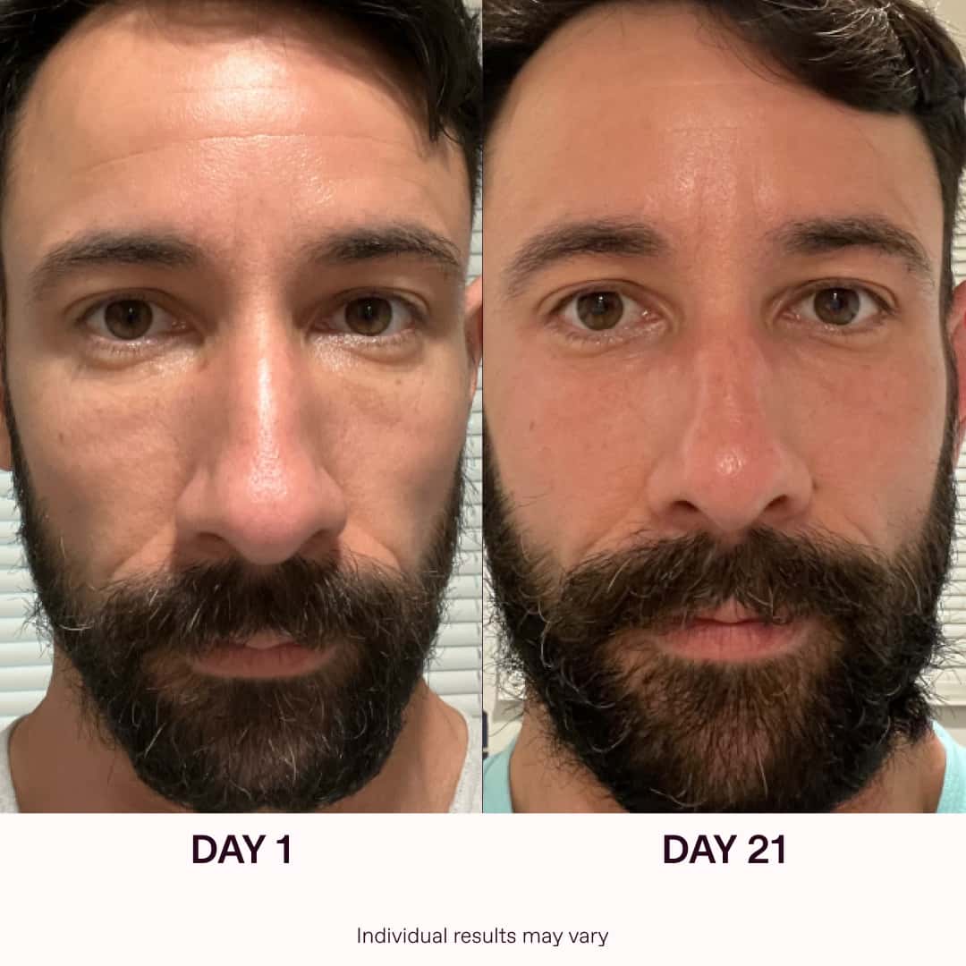 Red Light Therapy Before And After Results | Solawave