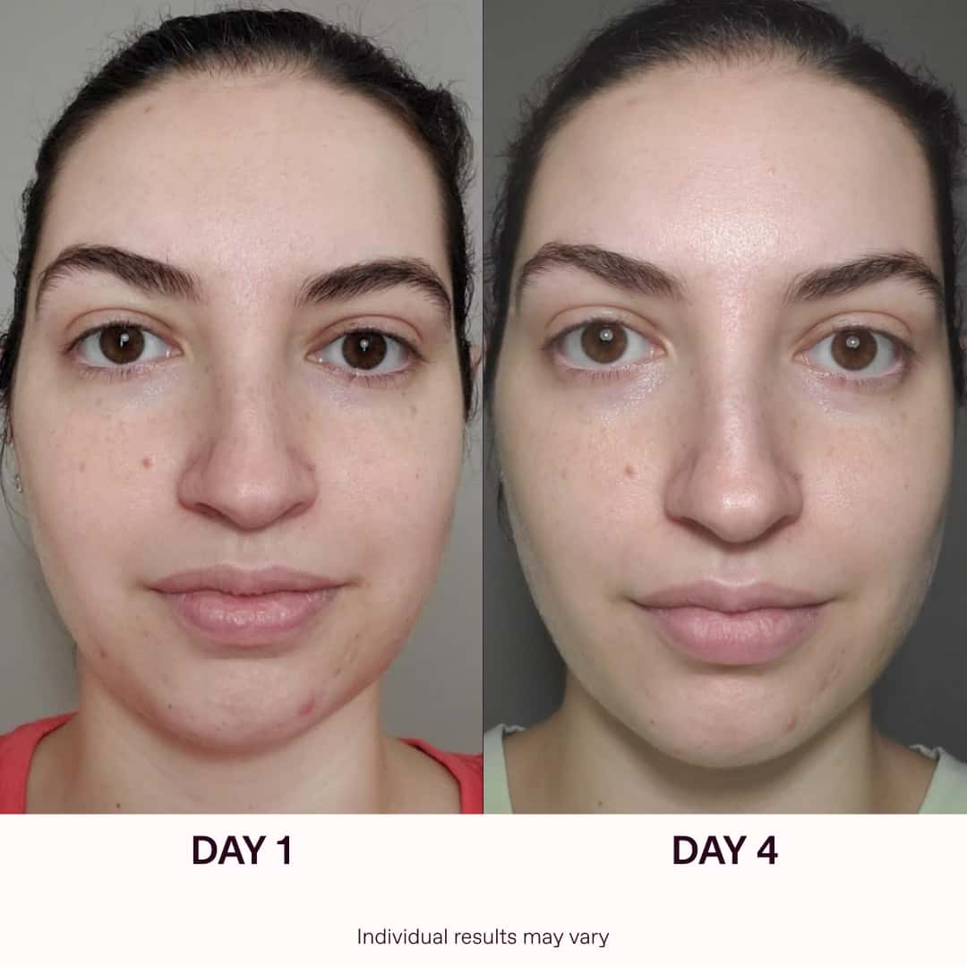 Red Light Therapy Before And After Results | Solawave