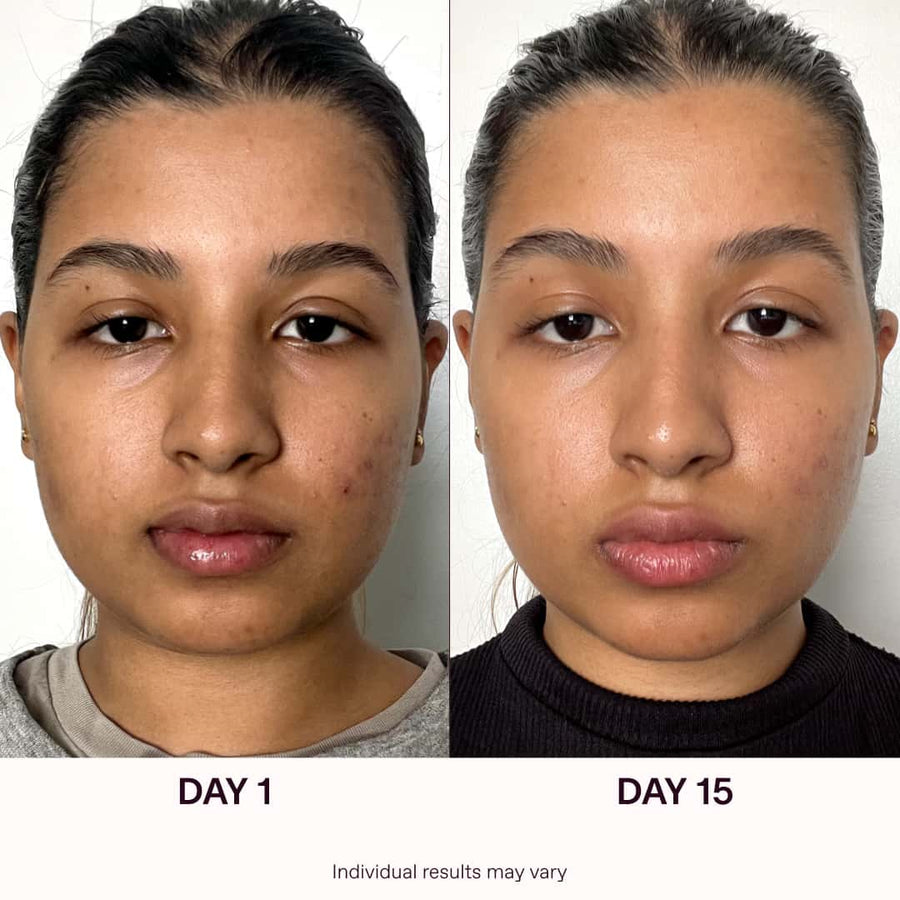 Blue Light For Acne Bye Acne Solawave