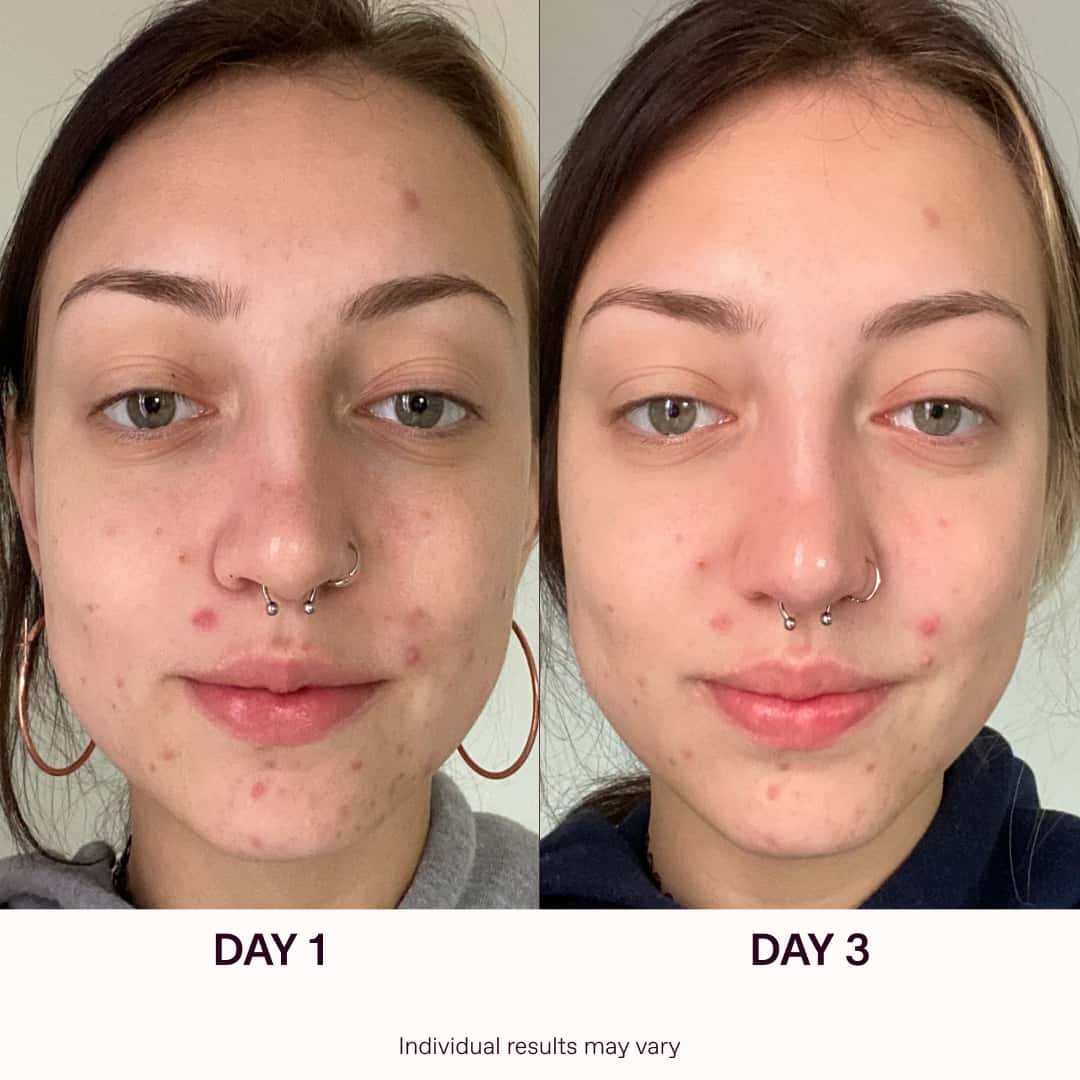 Red Light Therapy Before And After Results | Solawave