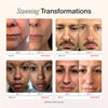 Solawave Strahlende Erneuerungsstab-Hauttherapie Vor Und Nach Der Rotlichttherapie