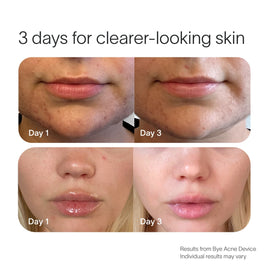 Two sets of before-and-after images show skin improvement. Top: Facial skin close-up with Bye Acne Pro Kit by SolaWave improving acne from Day 1 to smoother Day 3. Bottom: Lips and chin clearer by Day 3. Text: 3 days for clearer-looking skin with SolaWave. || Charcoal