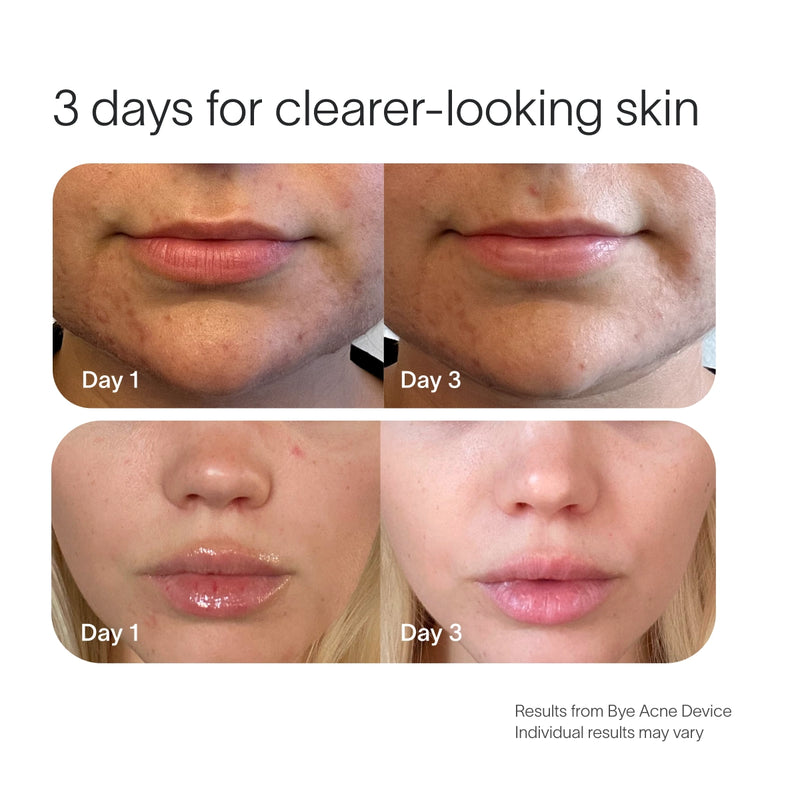 Two sets of before-and-after images show skin improvement. Top: Facial skin close-up with Bye Acne Pro Kit by SolaWave improving acne from Day 1 to smoother Day 3. Bottom: Lips and chin clearer by Day 3. Text: 3 days for clearer-looking skin with SolaWave. || Charcoal