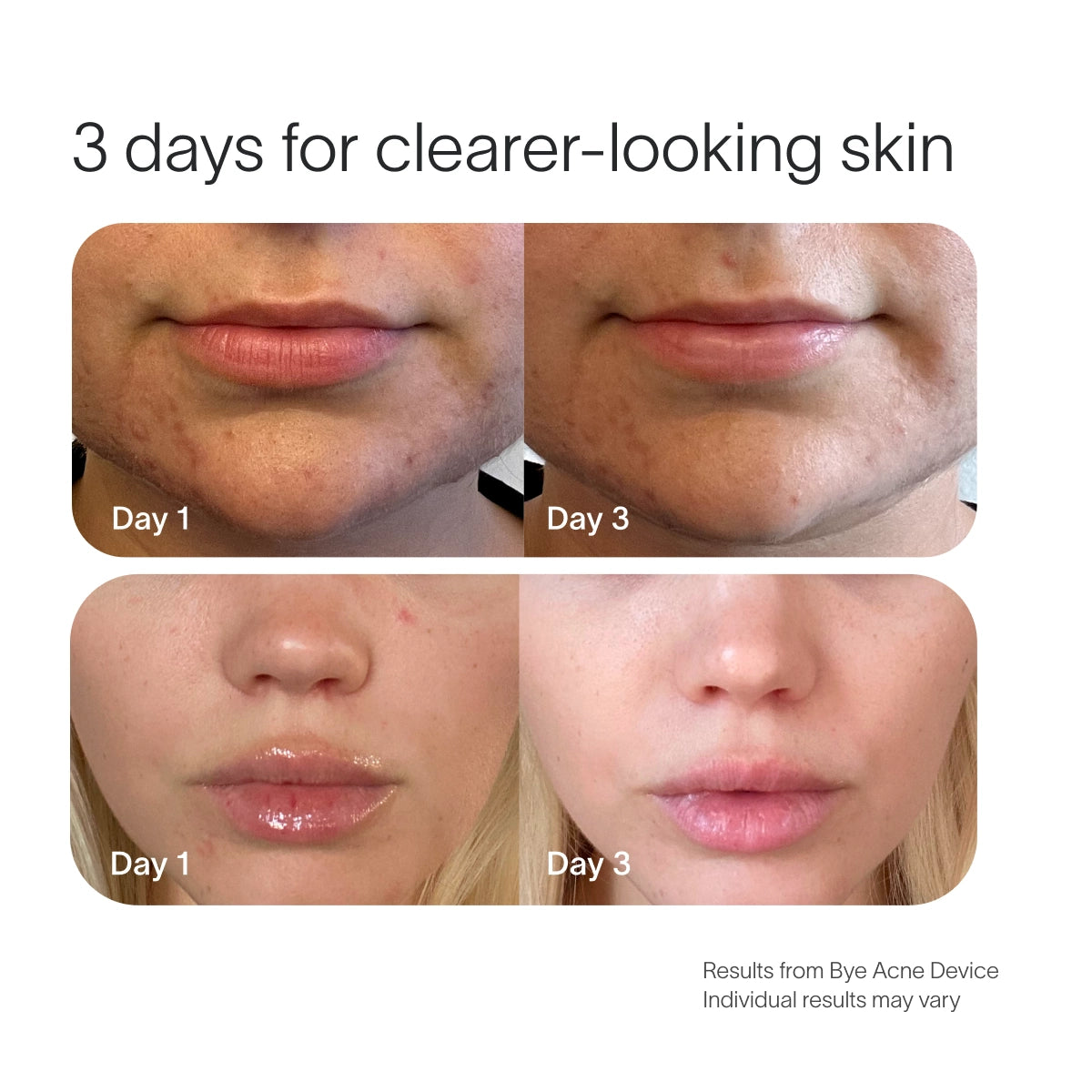 Close-up images show Day 1 and Day 3 chin and lips, highlighting blemish control improvement. Text reads 3 days for clearer-looking skin featuring SolaWaves Bye Acne Pro Kit. Results vary. || Periwinkle