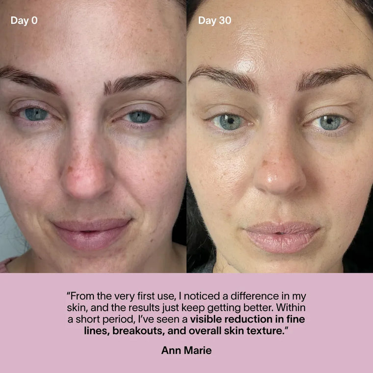 Side-by-side close-ups show significant skin texture, redness, and complexion improvement after 30 days using Solawave’s Wrinkle Retreat Face Mask & LightBoost Serum Kit. A customer testimonial appears below the images.