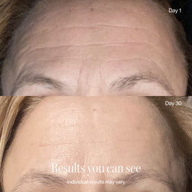 Close-up of a persons forehead comparing Day 1 (with wrinkles) to Day 30 after using Solawaves Wrinkle Retreat Face Mask & LightBoost Serum Kit. Text: Results you can see. Individual results may vary.