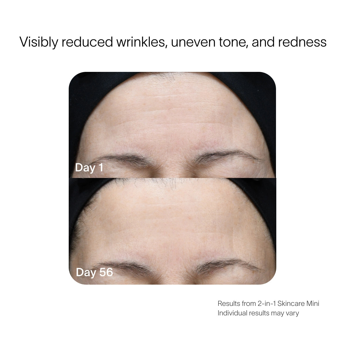A close-up photo comparison of a persons forehead using the SolaWave 2-in-1 Face & Body Mini Starter Kit. Day 1 shows wrinkles and uneven tone, while by Day 56, theres a smoother, more even complexion. Note: Individual anti-aging results may vary. before-after