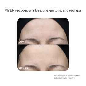 A close-up photo comparison of a persons forehead using the SolaWave 2-in-1 Face & Body Mini Starter Kit. Day 1 shows wrinkles and uneven tone, while by Day 56, theres a smoother, more even complexion. Note: Individual anti-aging results may vary. before-after