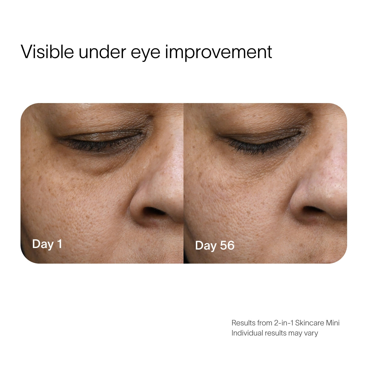 Side-by-side images display skin improvement over time. Left: Day 1 with visible under-eye lines. Right: Day 56 with smoother skin, using SolaWaves 2-in-1 Face & Body Mini Starter Kit anti-aging red light therapy. Individual results may vary. before-after