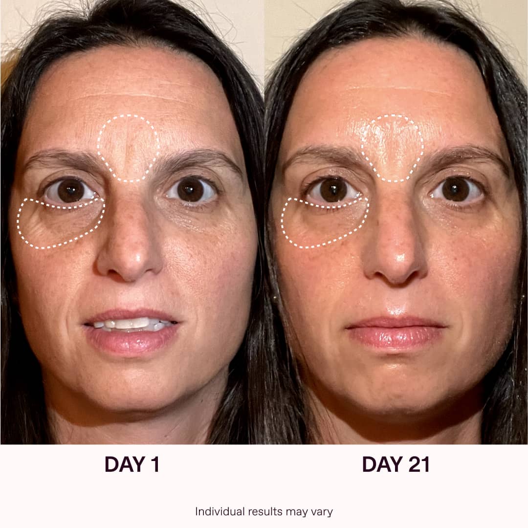 Red Light Therapy Before And After Results | Solawave