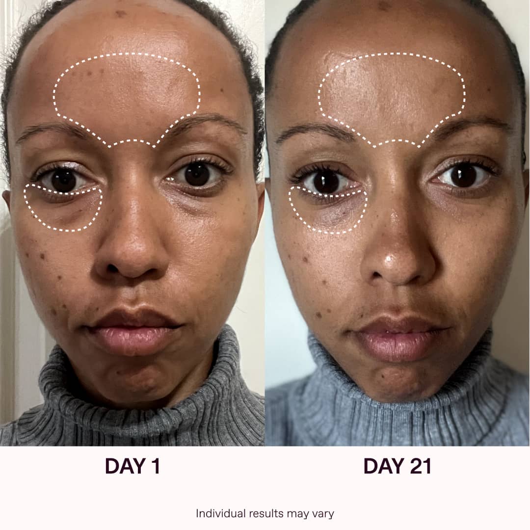 Red Light Therapy Before And After Results | Solawave