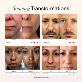 An image showing stunning transformations of red light therapy before and after || Charcoal