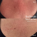 Before and after comparison of chest skin showing reduced redness and texture over 30 days.