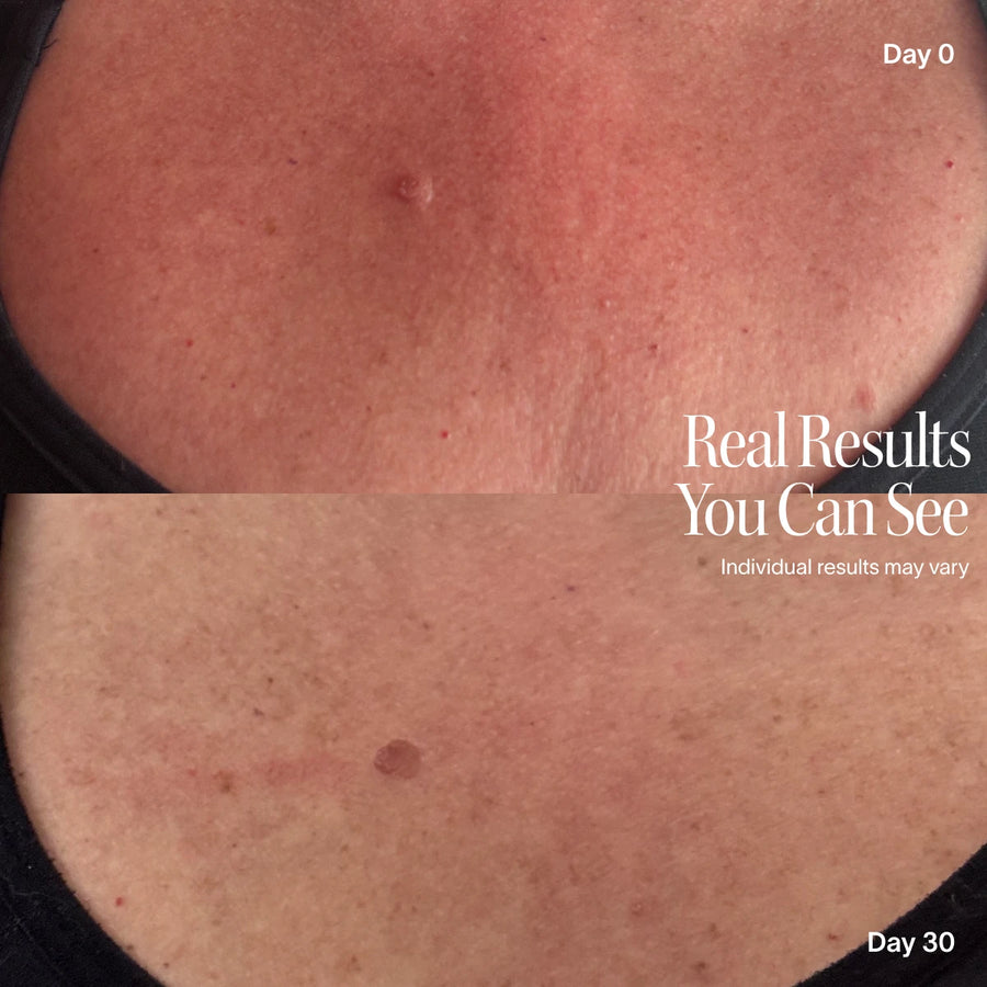 Neck & Chest Pro Light Therapy Mask