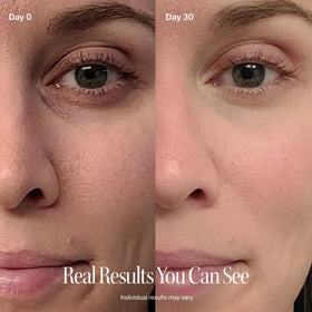 Before and after comparison of a woman's eye area with text 'Real Results You Can See'.  before-after || Gold