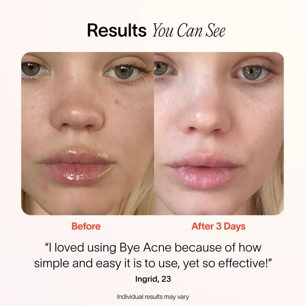 Bye Acne: 3-Minute Pimple Spot Treatment