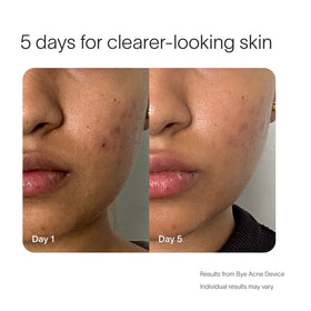 A side-by-side comparison of a woman's face shows acne on Day 1 and clearer skin on Day 5, illustrating the effectiveness of the SolaWave Bye Acne Pro Kit. Text notes that individual results may vary.