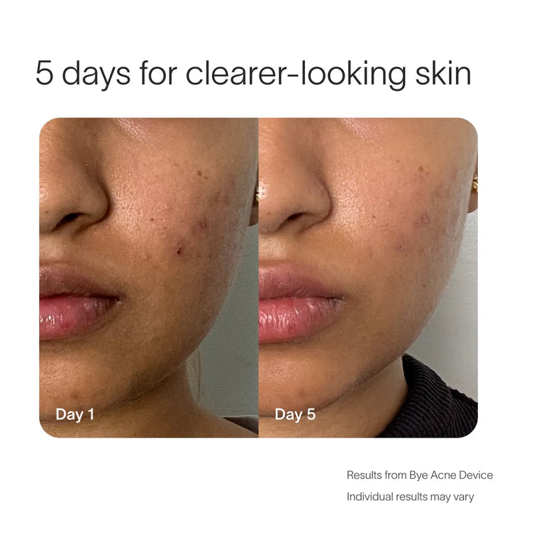 Side-by-side close-up photos show a person's lower face with acne on Day 1 and clearer skin on Day 5. Labeled "5 days for clearer-looking skin," they highlight how the SolaWave Bye Acne Pro Kit helps combat breakouts.