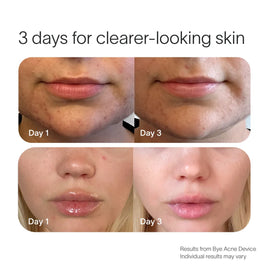 Before-and-after photos show smoother skin and reduced acne on two people after 3 days using the SolaWave Bye Acne Pro Kit with Blue and Red Light Therapies. Text: “3 days for clearer-looking skin.”.