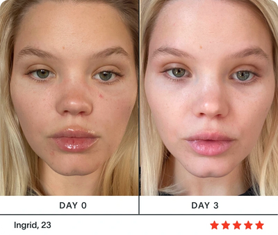 ansigtsbehandling med rødt lys før og efter